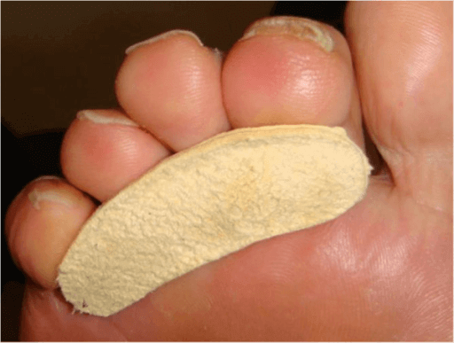 Hammertoes, Claw Toe, Mallet Toe And Blisters - Blister Prevention -  Rebecca Rushton