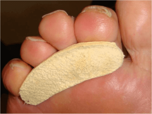 Thick toenail hammertoe