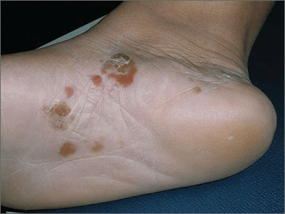 Vesicular tinea pedis are small itchy foot blisters