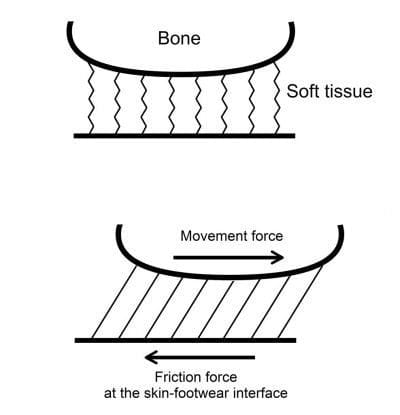 What causes blisters on feet - skin and bone moving out of sync re Hoffman 2016