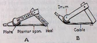 The windlass mechanism can explain arch blisters