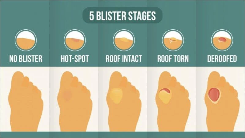 5 stages of blister development