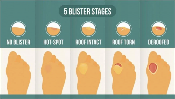 The 5 stages of blister development
