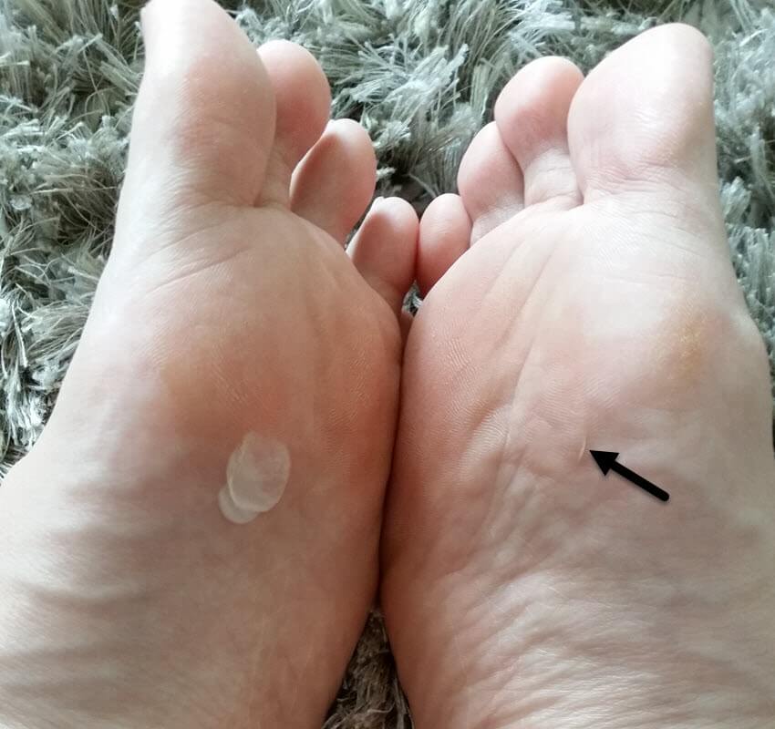 this is 30 days after initial blister injury