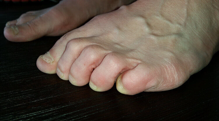 curly pinky toe is commonly blistered