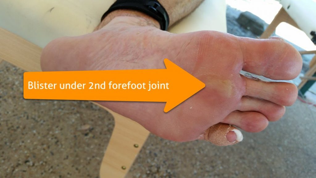 weightbearing blister under second forefoot joint