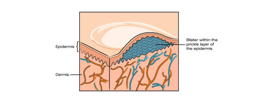 skin structure and blisters