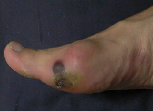 blood filled and callous covered edge blister at forefoot