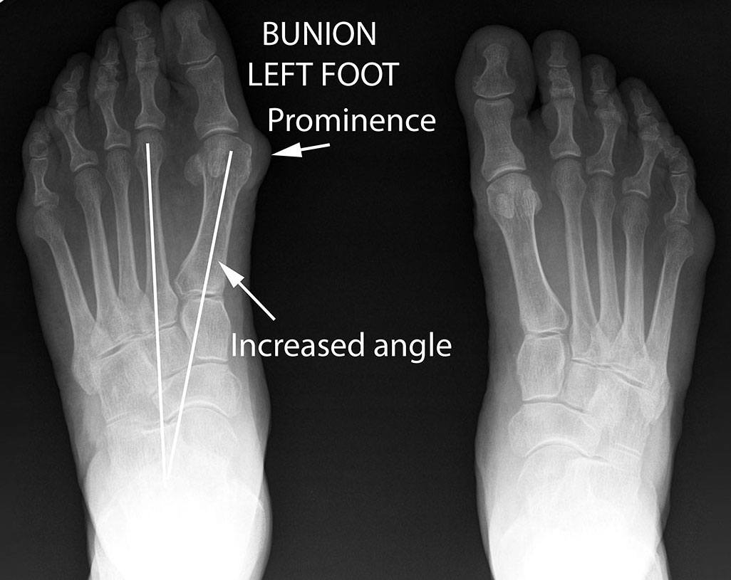 bunion xray bunions and blisters