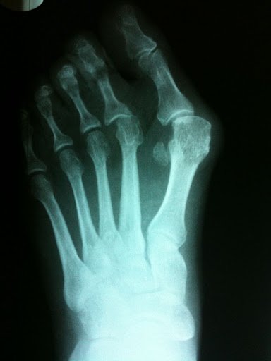 Xray: Severe bunion deformity. Notice the deviation of the big toe which exacerbates the prominence of the metatarsal head (the bunion).