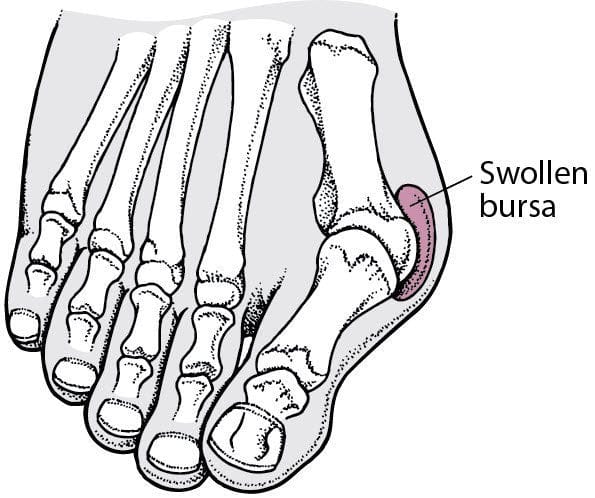 Bursa overlying bunion