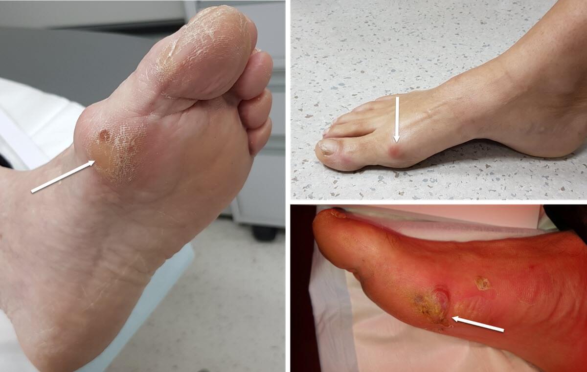 callouses, blisters and rubbing around bunions