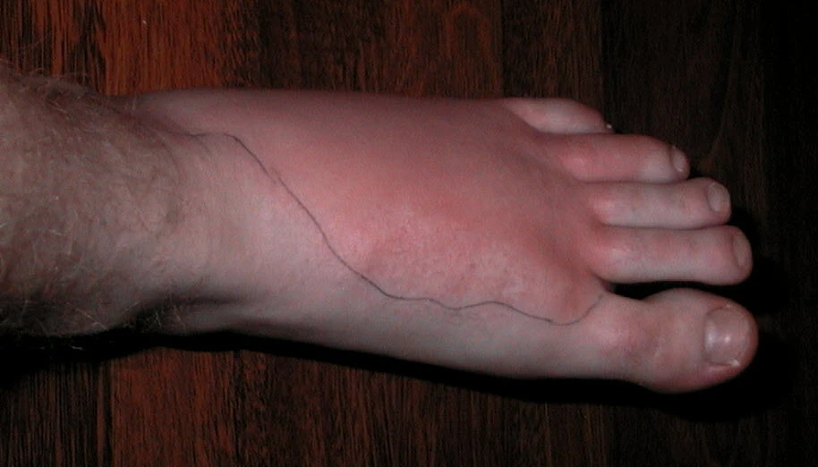 An infected blister can lead to cellulitis