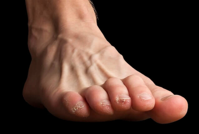 Clawed toes cause weightbearing pressure to be exerted on the end of the toenails
