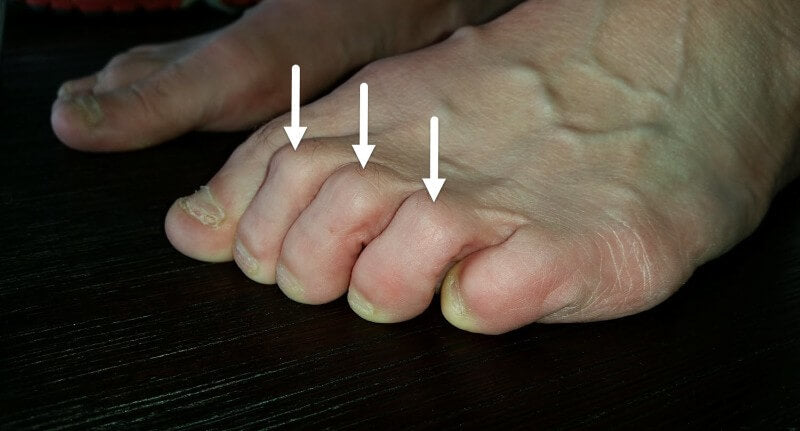 clawed toes blister top of toes
