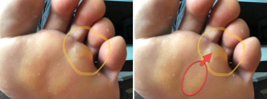 Distal Forefoot Blisters - cause versus location