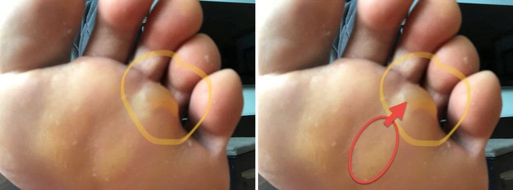 Distal Forefoot Blisters - cause versus location