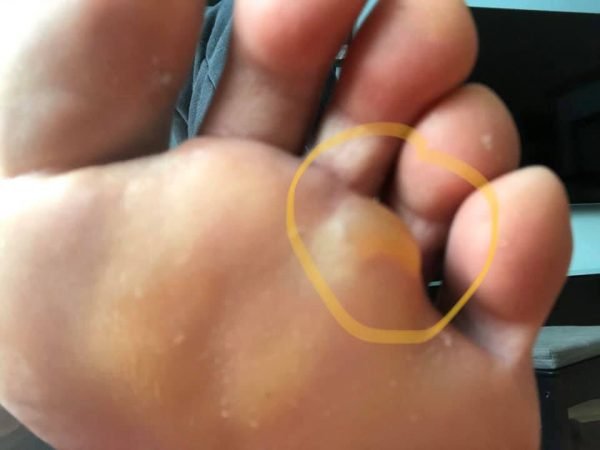 An example of a distal forefoot Blister (circled)