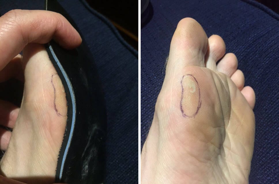 Bunions and blisters - see how this mild bunion bulges over the insole.