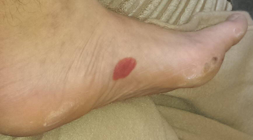 arch blister from new running shoes