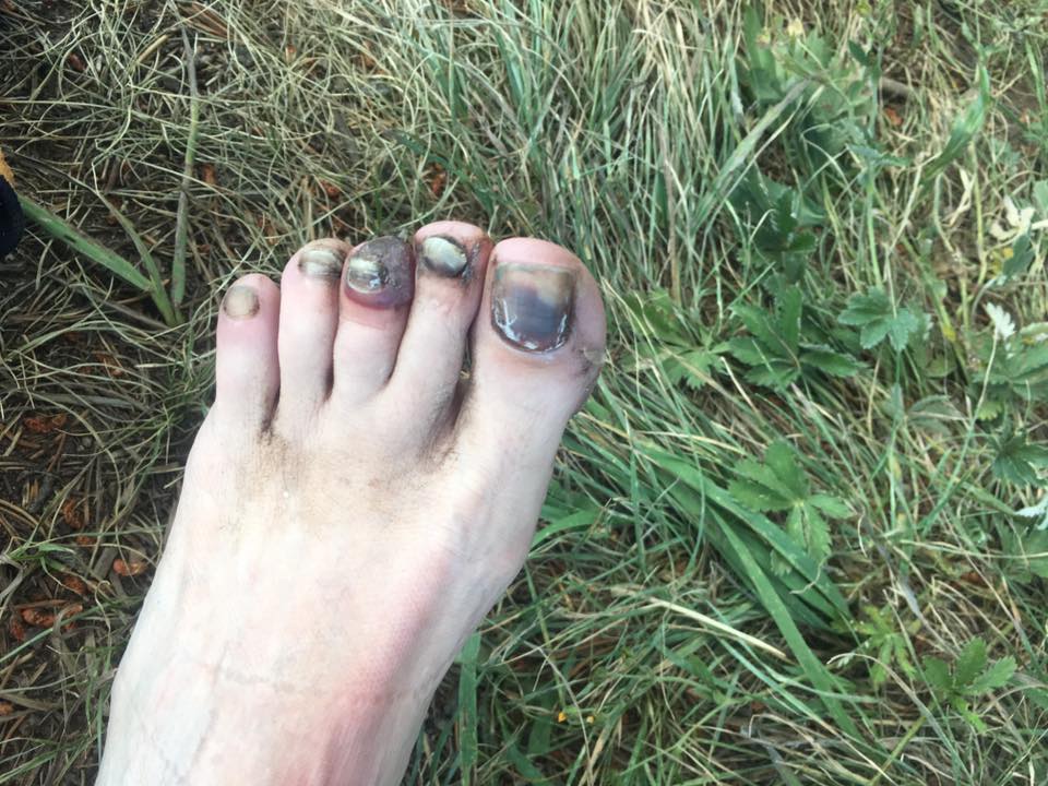 black toenail and toenail blood blister