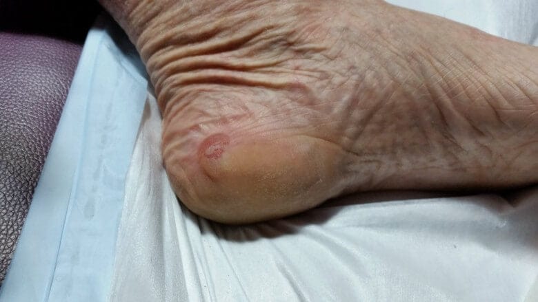 heel edge blister - the most common blister at ultramarathon events