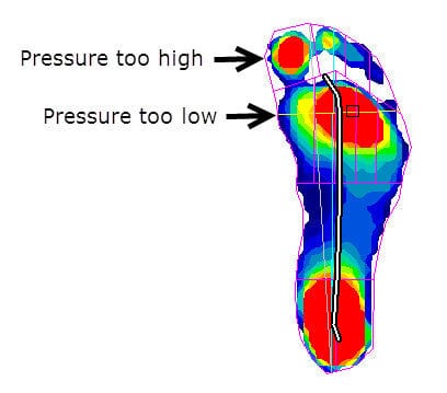 High pressure under the big toe (not under the MPJ) due to a functional hallux limitus (inefficient windlass mechanism)