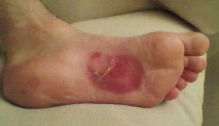 arch blisters from orthotics