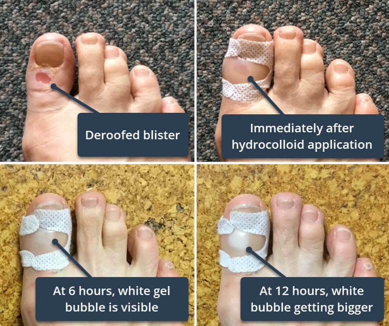 hydrocolloid white bubble healing timeline