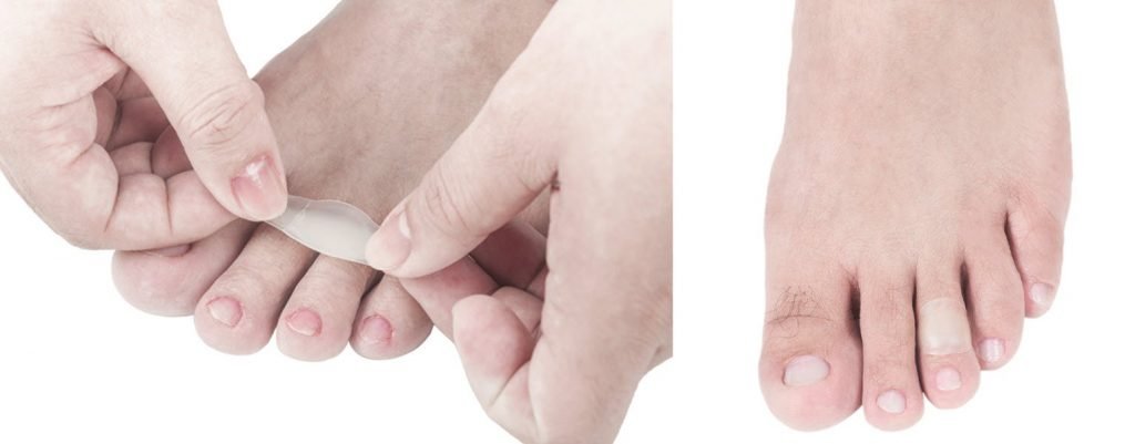 foot blister treatment for deroofed blisters - how to get rid of blisters on feet by matching the right dressing to your blister.