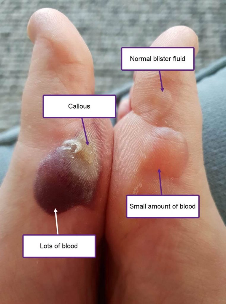 There are three blisters here. One is a typical blister (top right). The other two are blood blisters with varying amounts of blood in them, which effects the colour. here's also a callous involved with one of these blisters that might throw you off, so just thought I'd point that out.