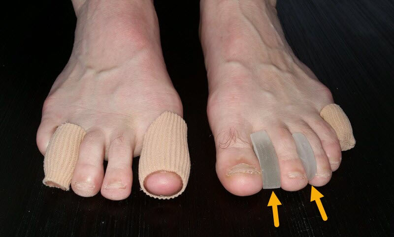 gel toe protectors for toe blisters, including blisters between toes