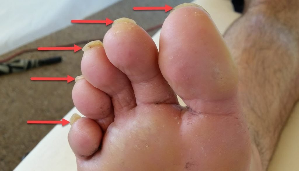 toenails too long - learn the importance of pre-race toenail care for runners