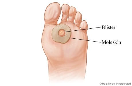 moleskin donut pads for blisters