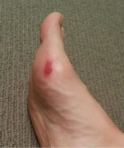 My hockey medial forefoot edge blister