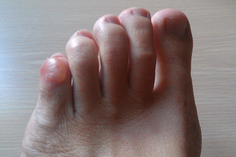 painful pinky toe blister