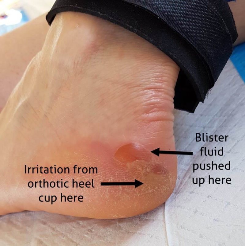 posterior lateral edge blister with blister fluid being pushed upwards