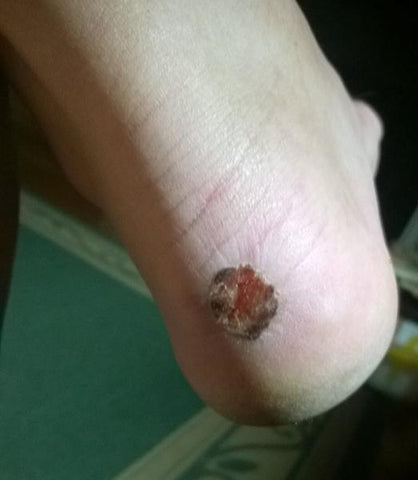 Scabbed blisterBlister treatment fail 5: Letting the air get to it so a scab forms. Part of this scab has dislodged revealing the raw weepy blister base again.