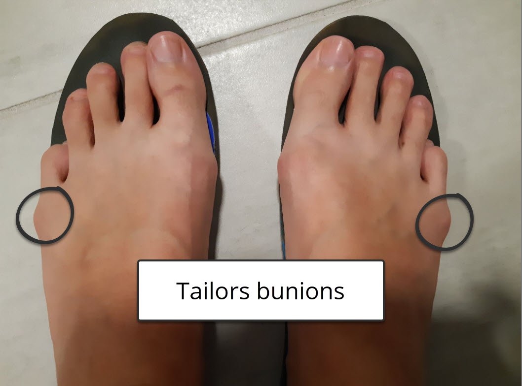 Bunions and blisters - specifically on tailors bunions or bunionettes