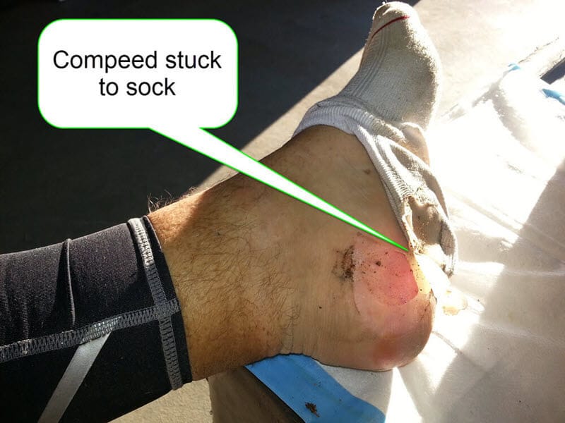 hydrocolloid dressing rolled-back a little and stuck to the sock 