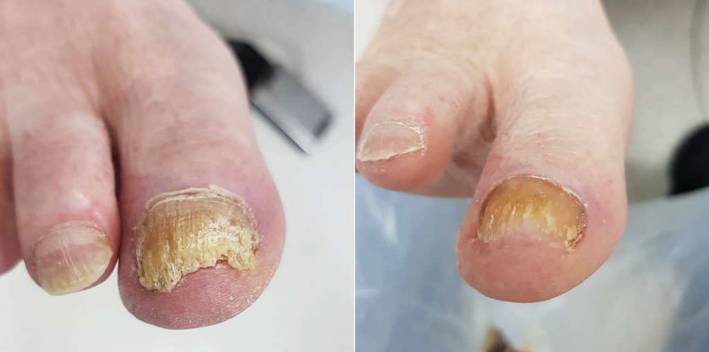 Thick fungal toenail before and after podiatry treatment