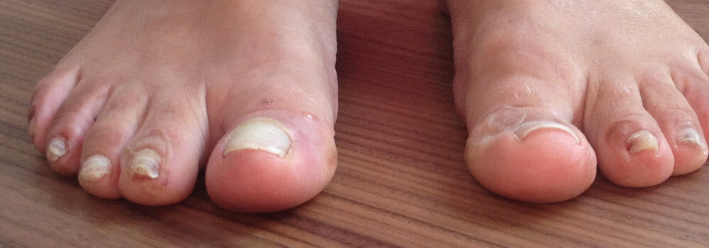 The middle 3 toenails of the right foot are too long, thick and rough. Keep them as thin and short and smooth as possible to avoid toenail blisters.
