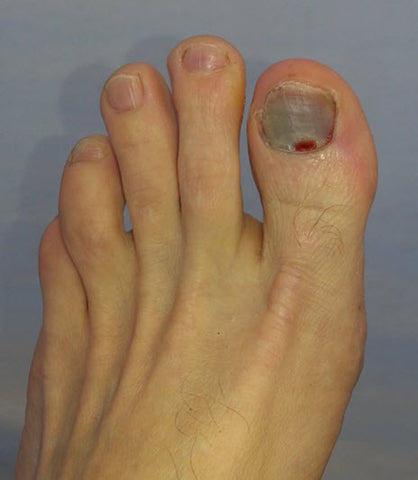 black nail of a runner