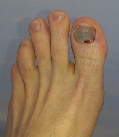 https://www.blister-prevention.com/cdn/shop/files/ultramarathon_runner_black_toenail_c3fe78c9-ce1c-4e86-9fd7-f6e660837da2_large.jpg