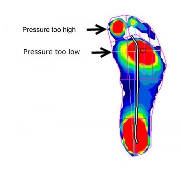 A functional hallux limitus puts more pressure under the big toe. Orthotics can change this.