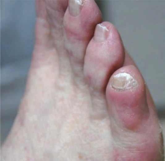Thick little toenail with varus twist