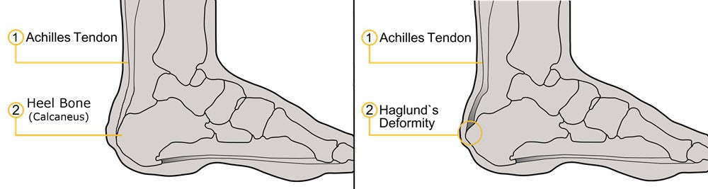 Achilles and Haglunds deformity