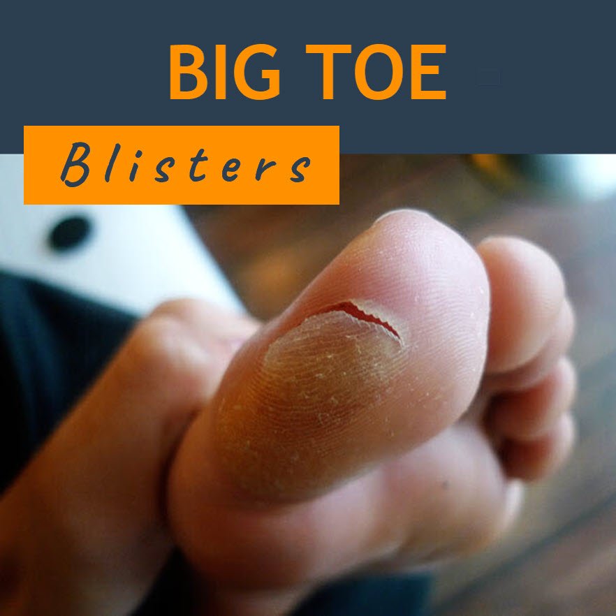 big toe blisters
