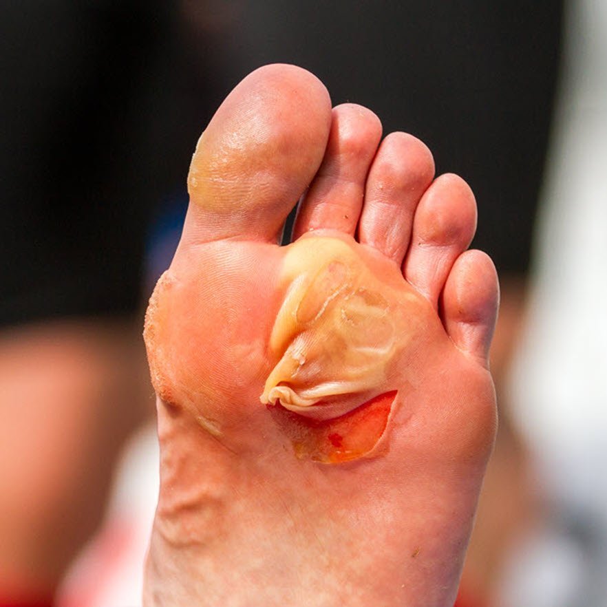blister under foot torn macerated