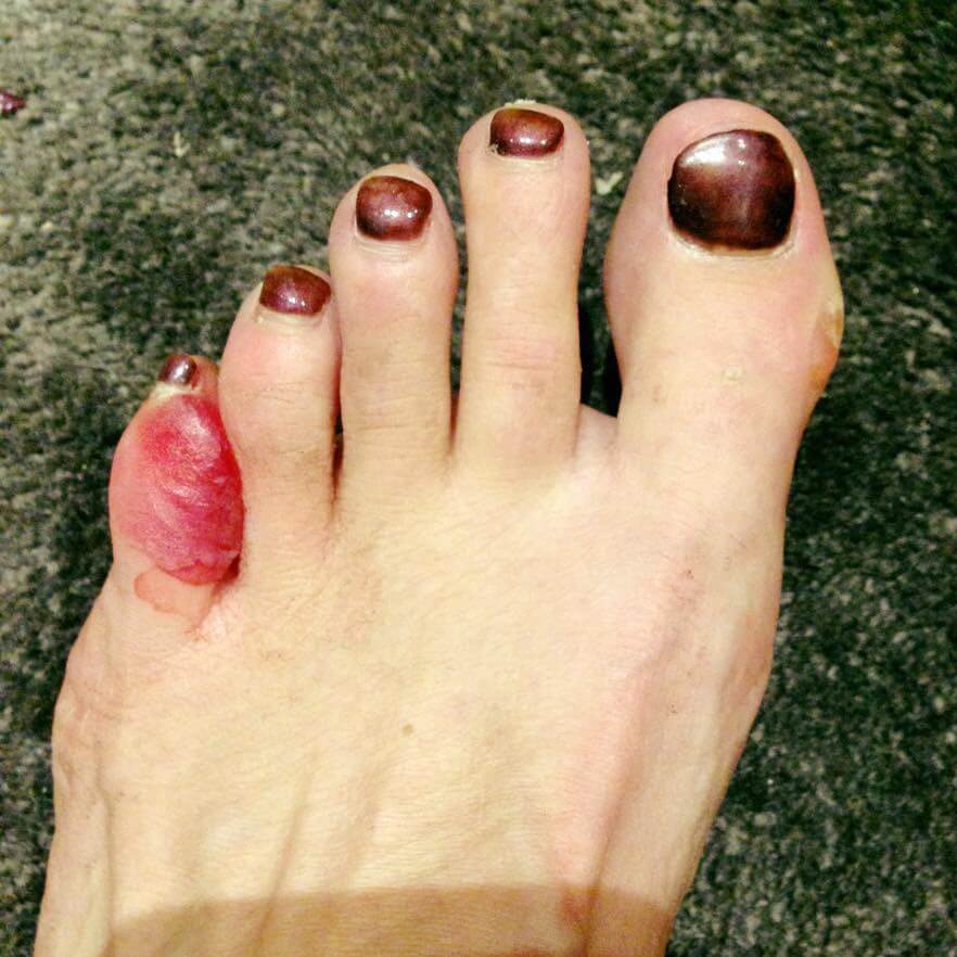 blisters between toes interdigital